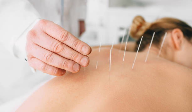 Benefits of Acupuncture